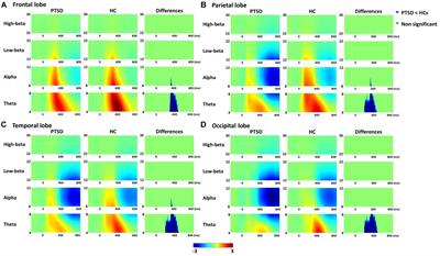 Impaired functional cortical networks in the theta frequency band of patients with post-traumatic stress disorder during auditory-cognitive processing